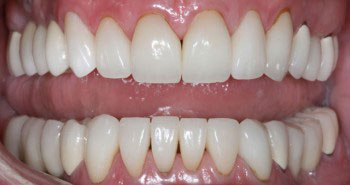 white teeth and tooth repair Casper Douglas WY - after