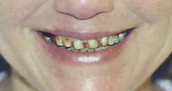 white teeth and tooth repair Casper Douglas WY - before