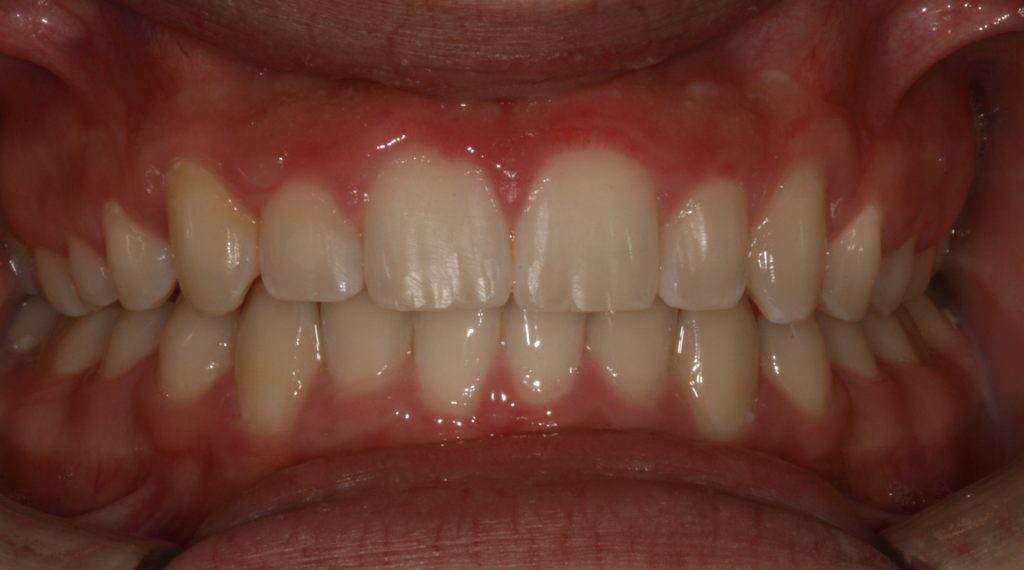 Smile Gallery - Cosmetic Dentistry Before and After Photos | Aspen