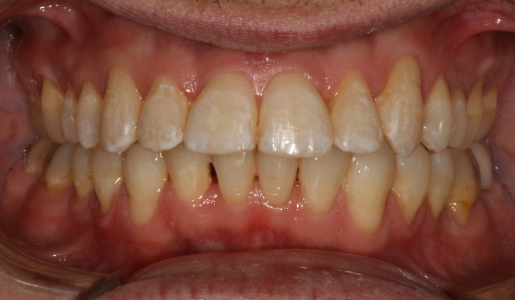 orthodontist Casper Douglas Wy - after