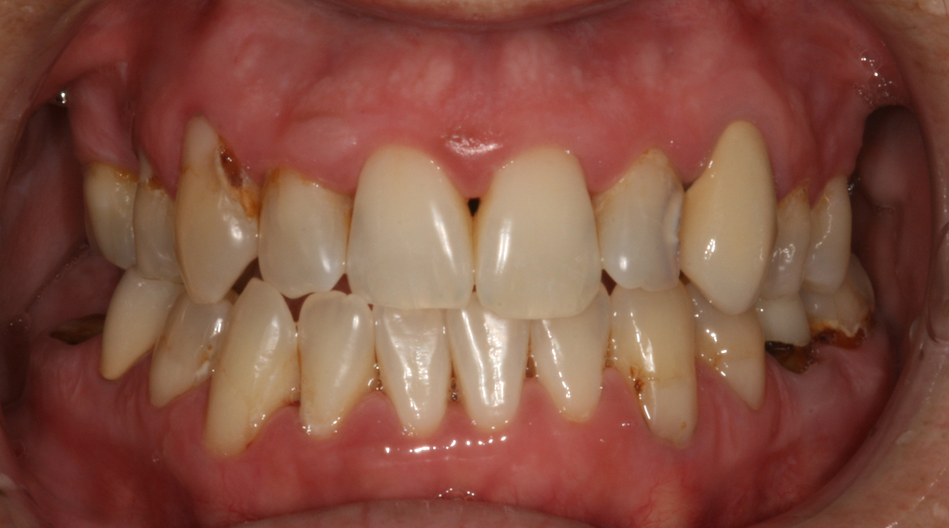 Smile Gallery - Cosmetic Dentistry Before and After Photos - Aspen ...