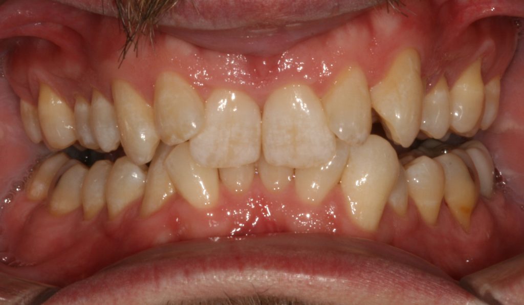 orthodontist Casper Douglas WY - before