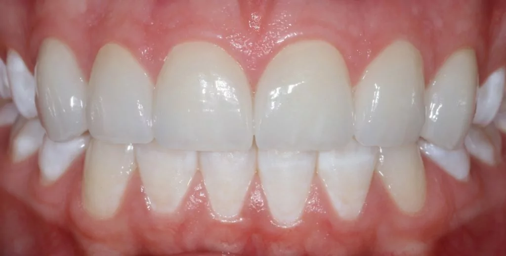 crown porcelain veneers Casper Douglas WY - after