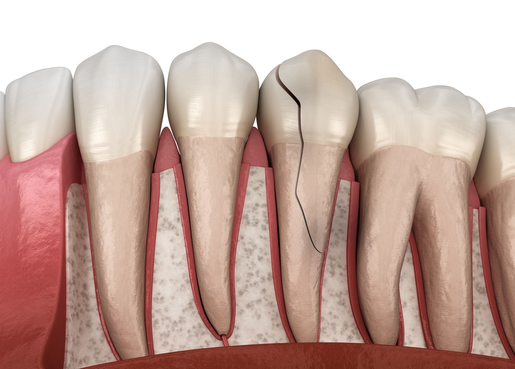 Dental Abrasions and Cracks - Implants, Wisdom tooth surgery, Root Canal  treatment, Crowns, Emergencies