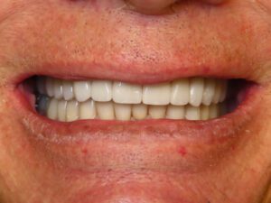 An Aspen Ridge Dental patient after restorative dental treatment.
