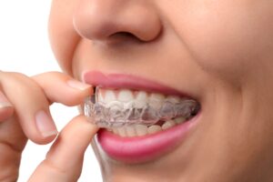 A young woman inserting a clear aligner.