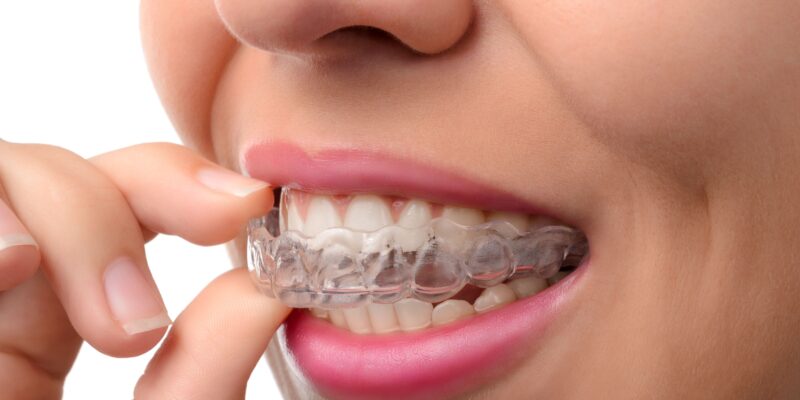 A young woman inserting a clear aligner.