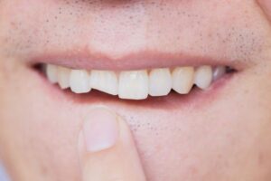 A person pointing to chipped tooth damage.