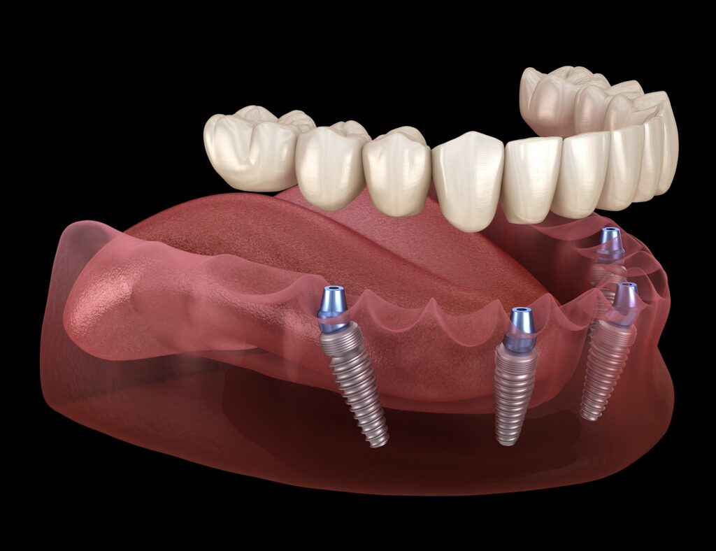 All on 4 implant supported dentures