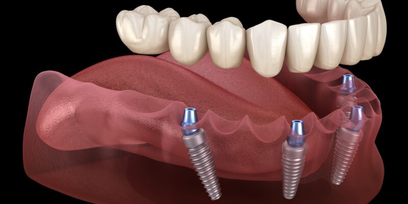 All on 4 implant supported dentures