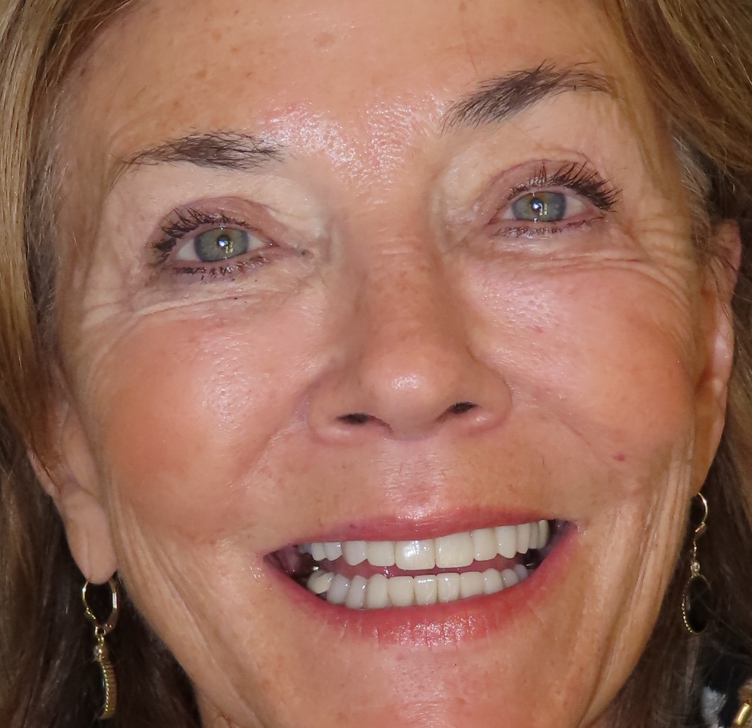 After photo - Smile transformation case 1