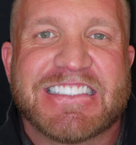 Aspen Ridge Dental patient after porcelain veneers in Casper.