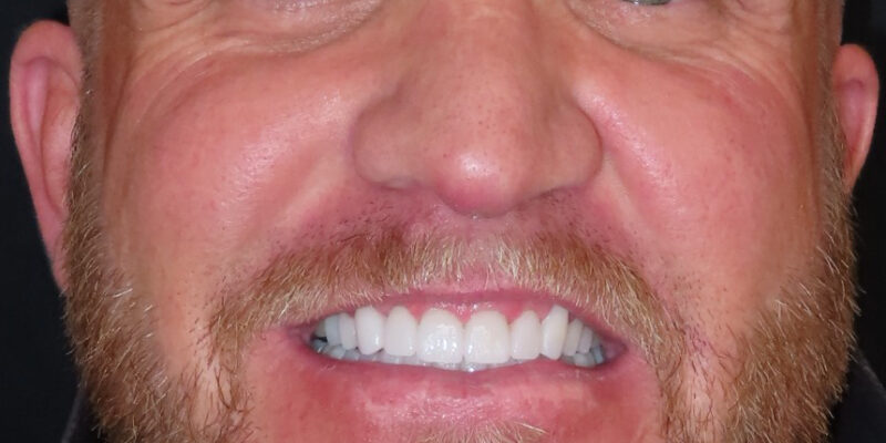 Aspen Ridge Dental patient after porcelain veneers in Casper.