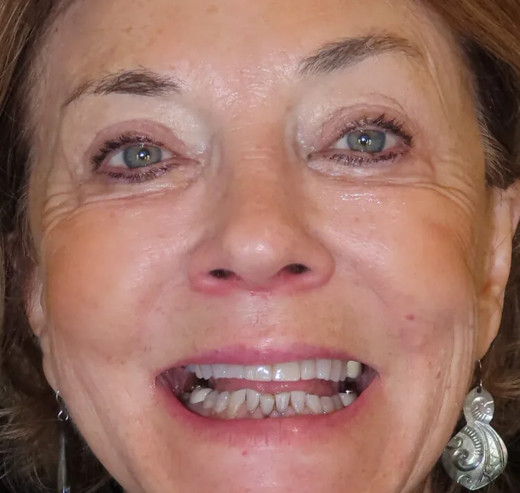 Before photo - Smile transformation case 1