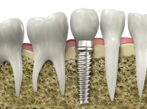 A graphic image of a dental implant embedded in a jawbone after treatment.